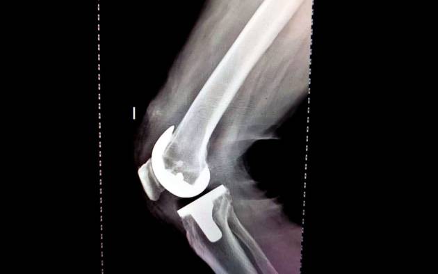 Cirugía de rodilla en Zapopan, Jalisco: especialistas en Traumatología y Ortopedia